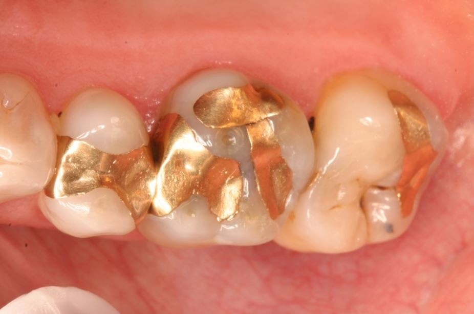 انواع ترمیم دندان و کامپوزیت رزین
